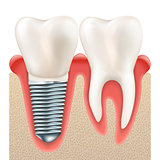 Dental implant set. EPS 10