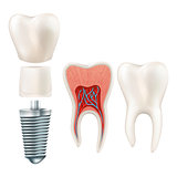 Dental implant set. EPS 10
