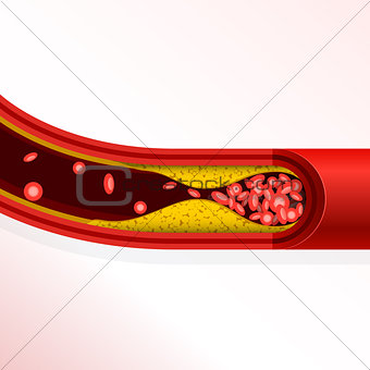 Thrombosis of artery - cholesterol buildup, arteriosclerosis 