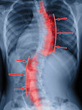 Scoliosis film x-ray spinal bend. Treatment concept