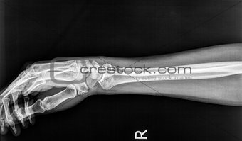 Fractures to the radius born of the right arm on an X-ray