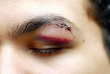 Injured eye